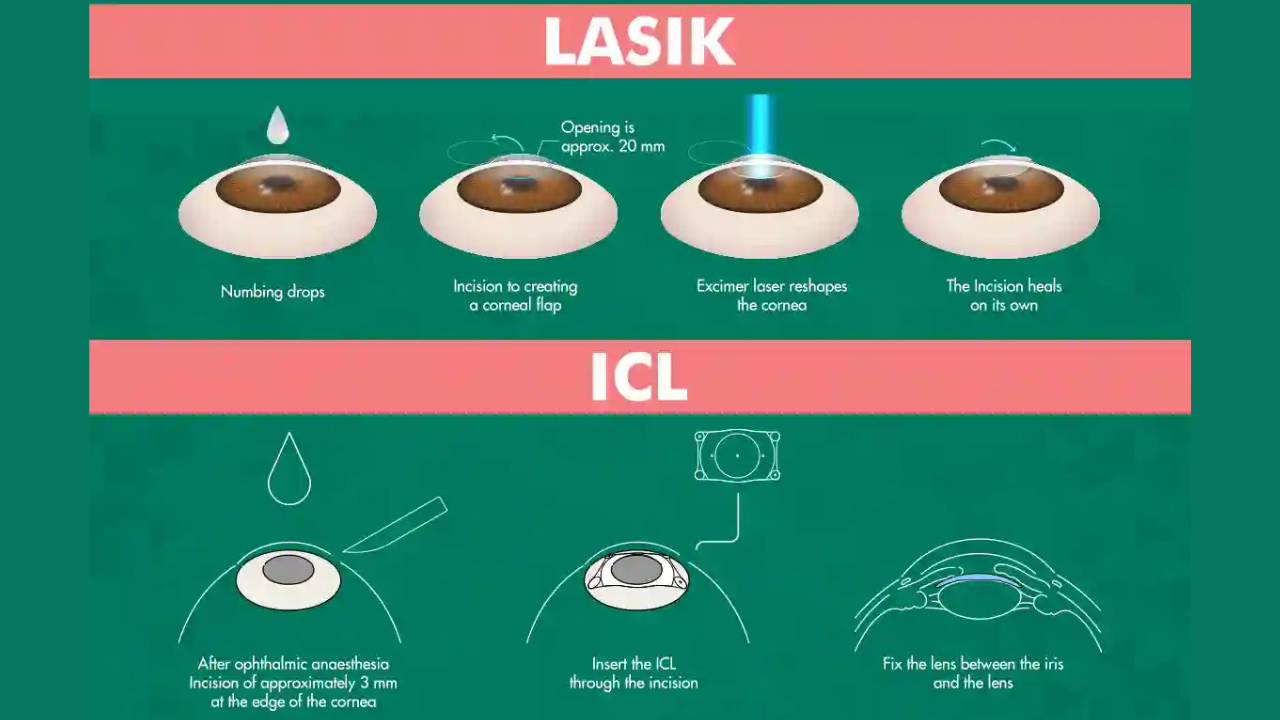 ICL Meaning: What Is ICL and Why Do People Get It? 2 ICL or LASIK, Which One Wins?